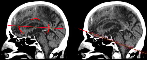 anterior and posterior knees of the collum callosum on the sagittal image