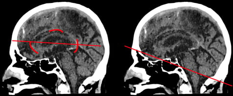 Abb.6: Sagittales Schnittbild mit Markierung des Collum callosum (links) und der Linie entlang der Schädelbasis (rechts)
