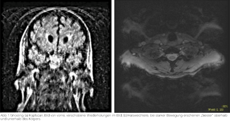 Bewegungsartefakte in der Radiologie