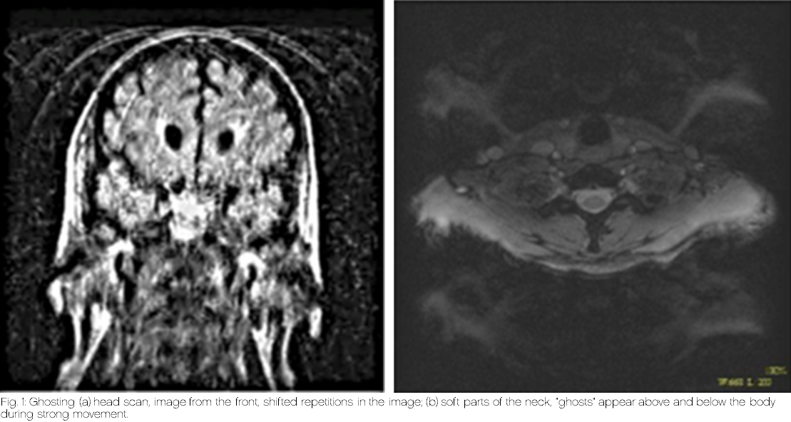 Motion artifacts in radiology