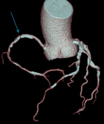 Herz 3d Aorta