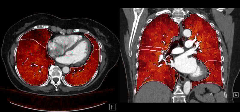 Perfusion Lunge_bei-Bedarf