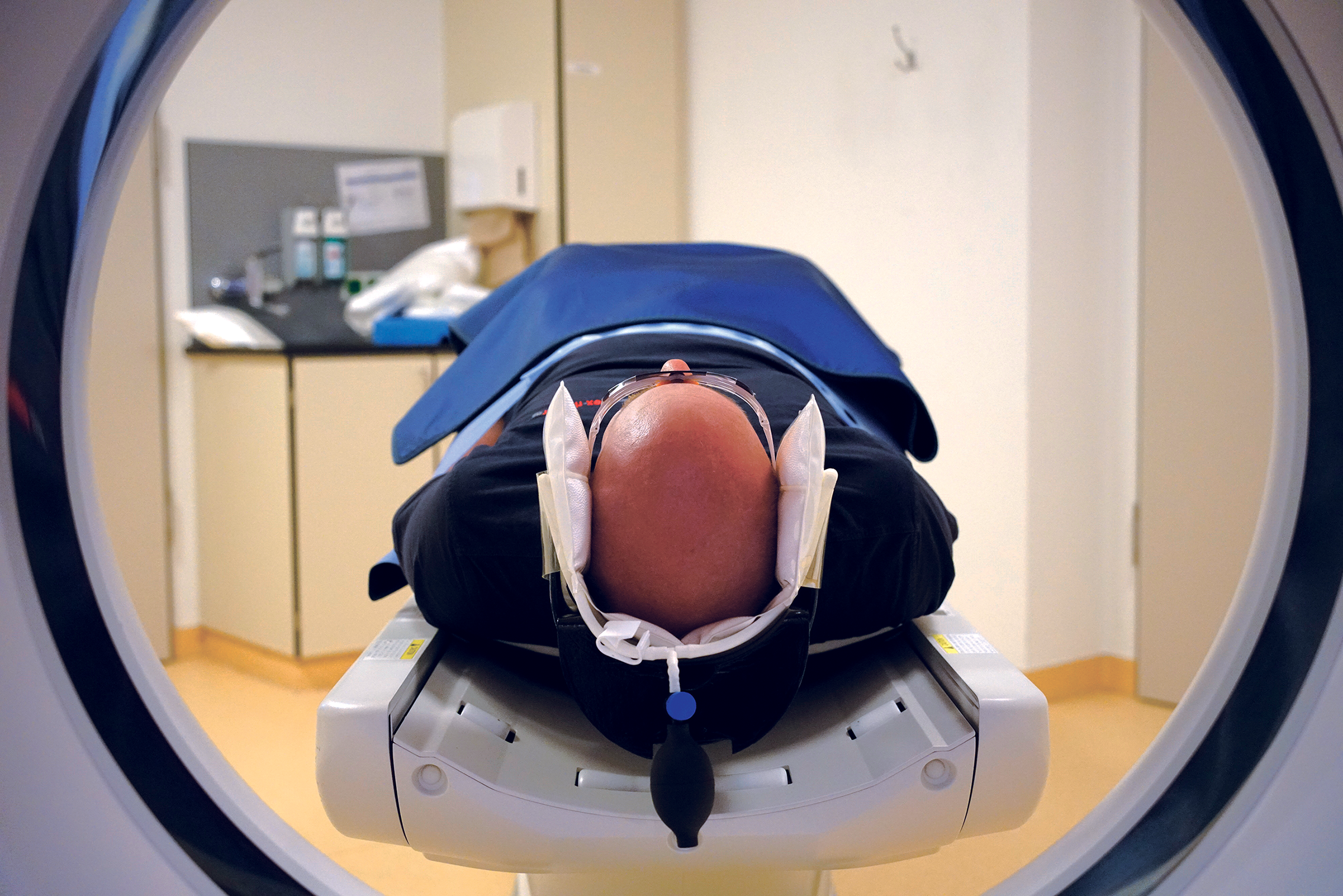 Patient head immobilized in head cradle with CT headFix